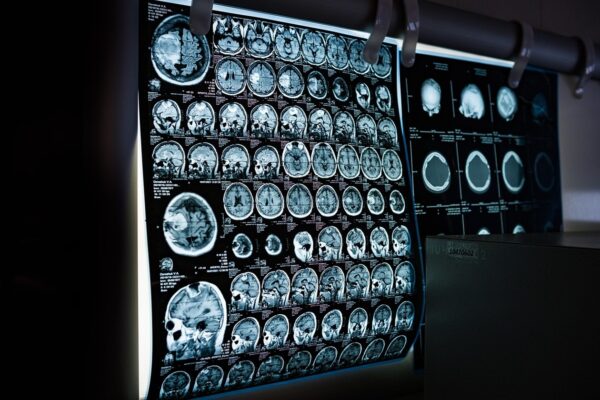 Два роки невідомої хвороби: у жінки діагностували пухлину мозку