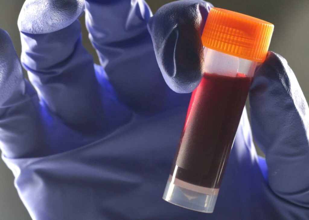 Вчені виявили зв’язок між групою крові та ризиком діабету 2 типу