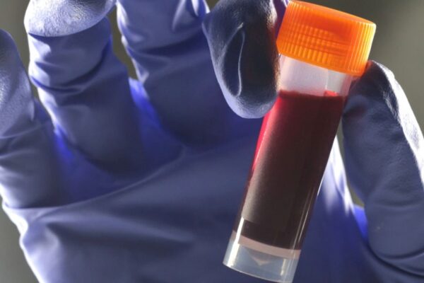 Вчені виявили зв’язок між групою крові та ризиком діабету 2 типу